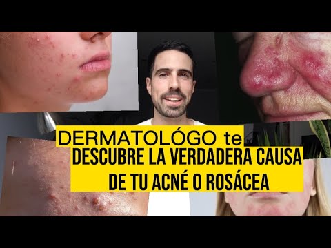 DERMATÓLOGO revela la CAUSA de ACNÉ y ROSACEA y su SOLUCIÓN ¡Líbrate de los granos para siempre!