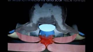 how to avoid periradicular lumbar fibrosis after lumbar disc surgery