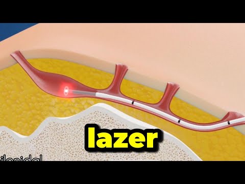 Kıl Dönmesi Ameliyatsız Lazer Tedavisi Animasyonlu Anlatım