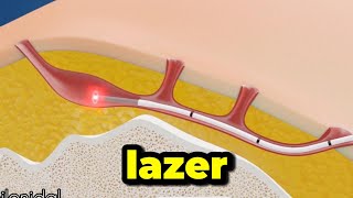 Kıl Dönmesi Ameliyatsız Lazer Tedavisi Animasyonlu Anlatım
