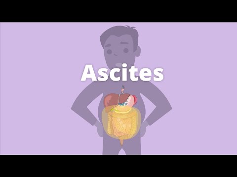 Cirrhosis – Ascites and pleural effusion