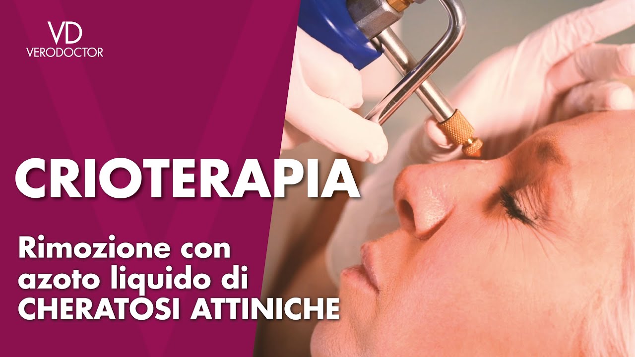 Crioterapia, rimozione con azoto liquido di cheratosi attiniche