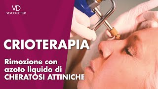 Crioterapia, rimozione con azoto liquido di cheratosi attiniche