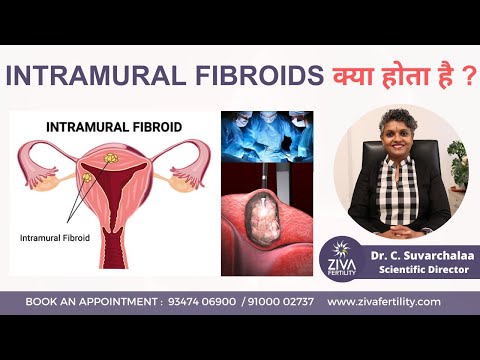 इंट्राम्यूरल फाइब्रॉएड: लक्षण, निदान और उपचार | Intramural Fibroid | Dr Suvarchala | ZIVA Fertility