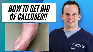 How to remove calluses from your feet | Dr. Nick Campitelli