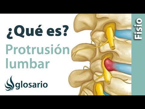 PROTRUSIÓN DISCAL LUMBAR | ¿Qué es?