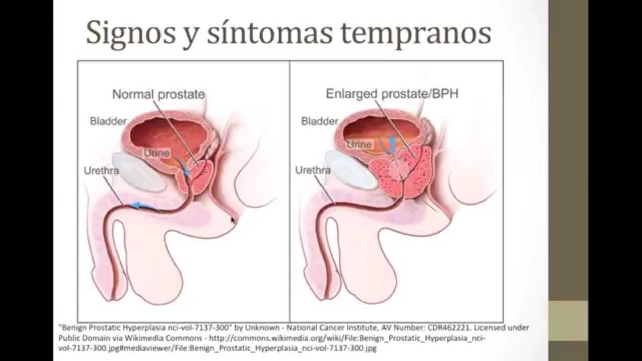 ¿Qué es el Cáncer de Próstata?