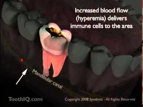 5 Absceso Dental