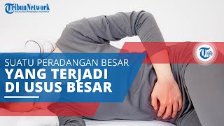 Kolitis Ulseratif, Suatu Peradangan Kronis yang Terjadi pada Usus Besar dan Rektum
