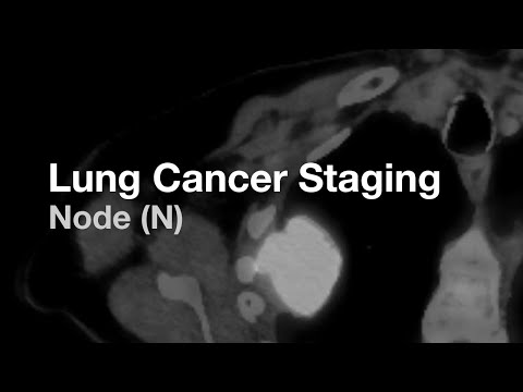 Lung Cancer Staging - Node (N)