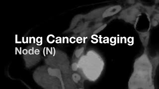 Download lagu Lung Cancer Staging - Node (N) mp3