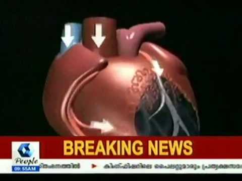 Dr. S. Ramasamy Explains EECP Natural Bypass for Heart Care