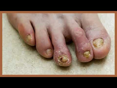 Isang anti-fungal singit Kuko halamang-singaw advanced na mga paraan ng litrato