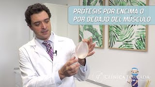 Prótesis por encima o por debajo del músculo