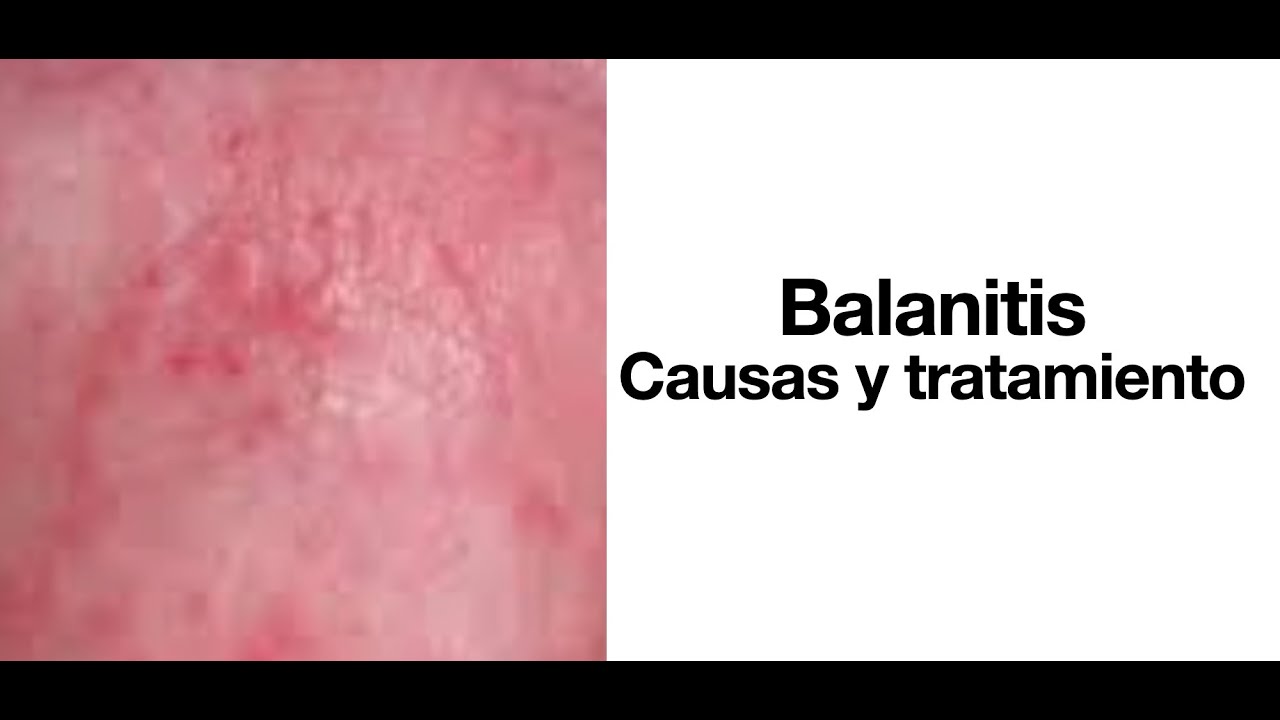 Balanitis: Causas y tratamiento - Cura de la balanitis