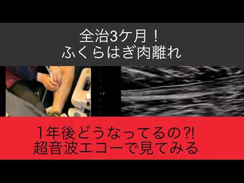 ふくらはぎ肉離れ　1年後のエコー確認