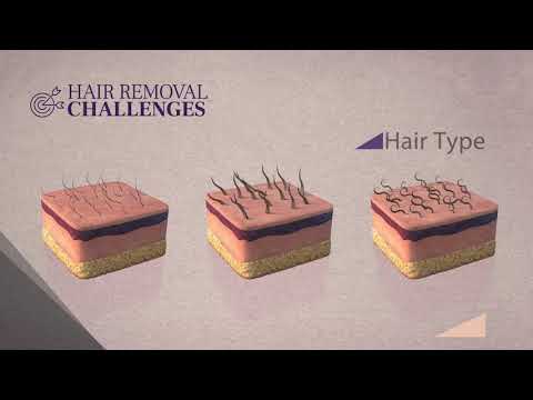 SHR 3D Technology - Soprano laser hair removal