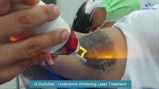 Q-Switched Underarms Whitening Laser Treatment