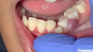 Severe Gum Abscess In A 10 Year Old