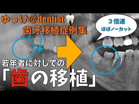 生命歯学科 【閲覧注意】ほぼノーカット　若年者の歯の移植　親知らずは抜かずに使え！　歯根未完成の歯に対して行う歯牙移植術について　動画解説しています