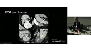 Computed Tomography for TAVI – Dr James Otton