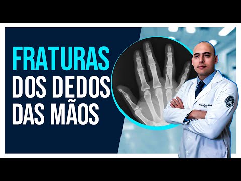 FRATURAS DOS DEDOS DAS MÃOS | COMO É O TRATAMENTO E RECUPERAÇÃO?