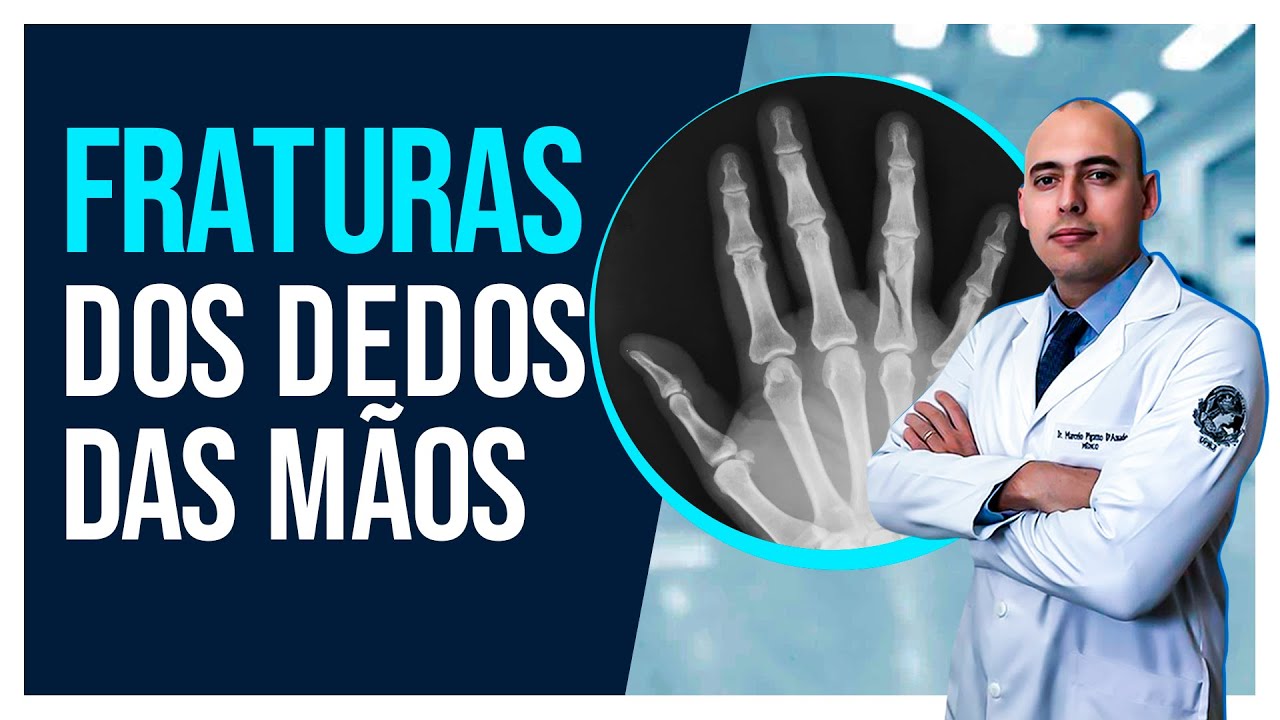 FRATURAS DOS DEDOS DAS MÃOS | COMO É O TRATAMENTO E RECUPERAÇÃO?