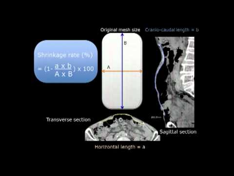 Laparoscopic Ventral Hernia Repair 