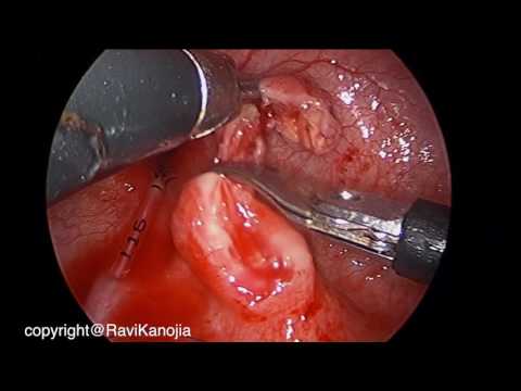 Réimplantation urétéro-vésicale par voie vésicoscopique en raison de reflux vésico-urétéral et un diverticule