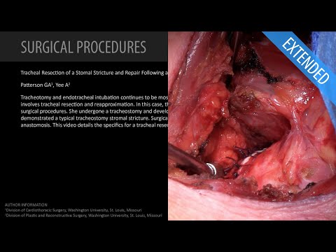 Résection trachéale d'une stomie stomale et réparation - Prolongée (avec Dr. Patterson)