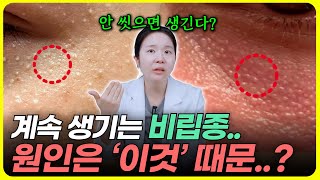 비립종 압출, 제거 하면 안 된다? 의사가 알려주는 비립종·한관종·편평사마귀 구별법