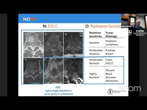 25. The Ever-Changing Role of Surgery in the Treatment of Metastatic Spine Tumors by Dr. Mark Bilsky
