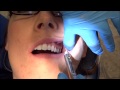 PSA Injection PART 2
