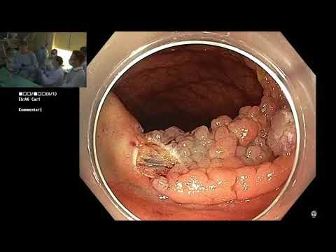 04/20 - Live-Endoskopien