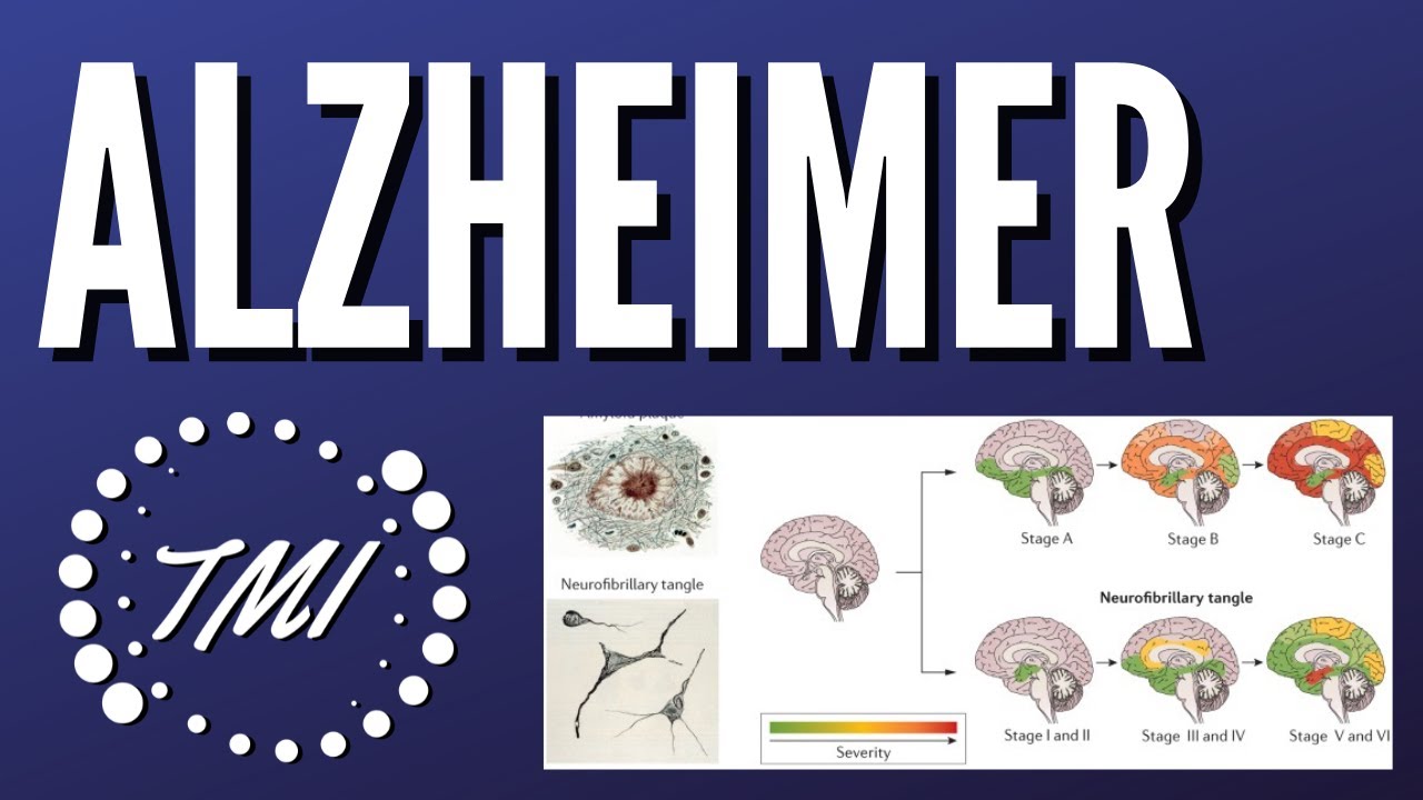 Enfermedad de Alzheimer y Deterioro Cognitivo Leve Explicados Claramente