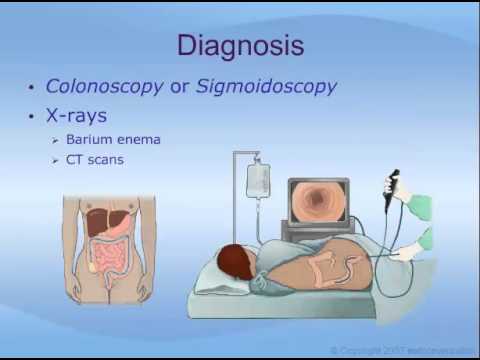 Ulcerative Colitis - YouTube