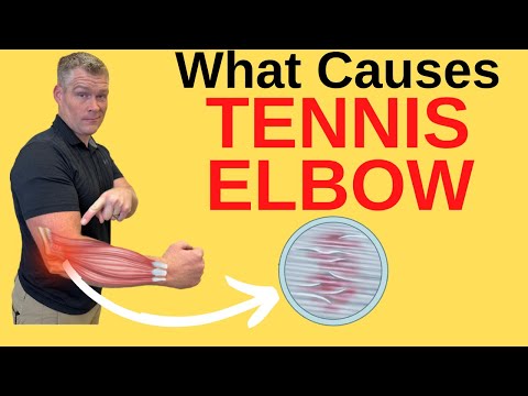 What Causes Tennis Elbow (Lateral Epicondylitis)? 1/9