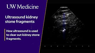 Newswise:Video Embedded new-tech-gives-kidney-stone-patients-options2