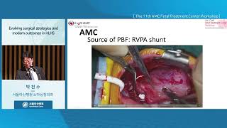 The 11th AMC Fetal Treatment Center Workshop : Evolving surgical strategies and modern outcomes in Hypoplastic left heart syndrome 미리보기