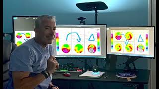 Download Lagu From India 🇮🇳 to Athens, 🇬🇷, to transform keratoconus darkness to vision! Kanellopoulos, MD Thumbnail