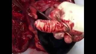 Cardiac Tamponade - Post-Mortem Gross Specimen