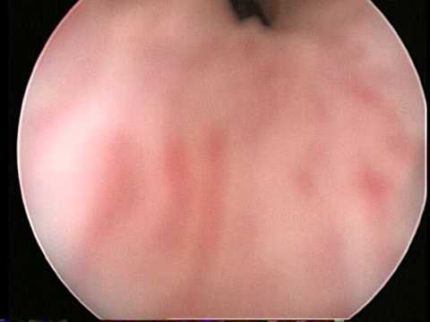 Qualsiasi esercizio da eseguire a un osteocondrosi Gomito tirato