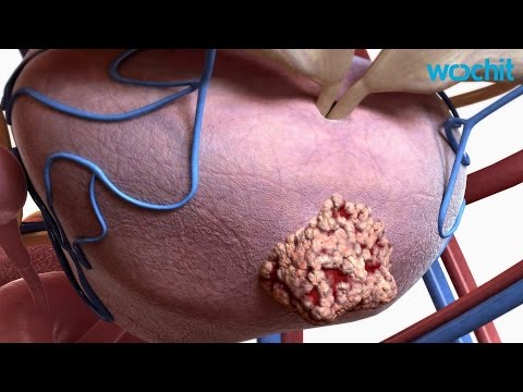 Diffuse Veränderungen im Parenchym der Prostatitis, was es ist Massage Prostatamassager