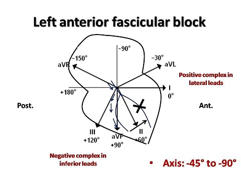 ECG course: Fascicular Blocks, Dr. Sherif Altoukhy