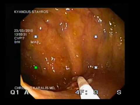 Escisión de pólipo plano en el colon
