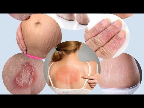 Itch Cream Ringworm Antifungal Cream ,Rudramani Ointment