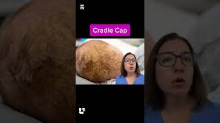 Cradle Cap Explained | Newborn Nursing Care: Pediatrics SHORT | @LevelUpRN