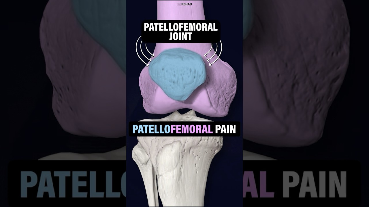 What Is Patellofemoral Pain (Runner’s Knee)? #shorts