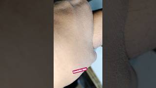Cannulation..video..part  1081 #shorts #viral #vigo