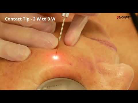 K-Laser Blue Derma - Carly Whytcross - Milia Laser treatment